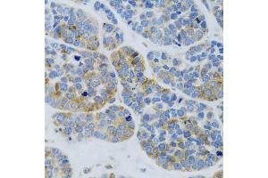 Immunohistochemistry of paraffin-embedded Human esophageal cancer using MBL2 antibody (ABIN6132334, ABIN6143597, ABIN6143600 and ABIN6221519) at dilution of 1:100 (40x lens). (MBL2 抗体  (AA 21-248))