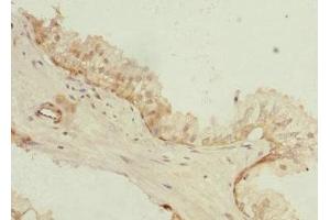 Immunohistochemistry of paraffin-embedded human prostate cancer using ABIN7163670 at dilution of 1:100