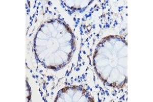 Immunohistochemistry of paraffin-embedded human colon carcinoma using GCAT antibody (ABIN7267461) at dilution of 1:100 (40x lens). (GCAT 抗体  (AA 170-419))