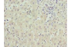 Immunohistochemistry of paraffin-embedded human liver cancer using ABIN7176363 at dilution of 1:100 (ZNF544 抗体  (AA 1-230))