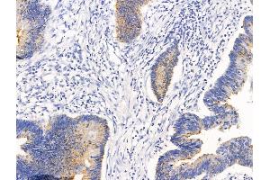ABIN7094680 and ABIN7098731 at 1/100 staining Human colorectal cancer by IHC-P. (CLCA1 抗体  (C-Term))