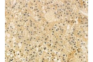 ABIN6259556 and ABIN6274915 at 1/100 staining human hepatocellular carcinoma by IHC-P. (GUSBP2 抗体  (Internal Region))