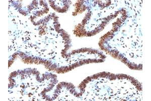 Formalin-fixed, paraffin-embedded human Ovarian Carcinoma stained with SUMO-2 Monoclonal Antibody (SUMO2/1199) (SUMO2 抗体)