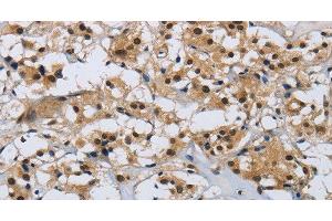 Immunohistochemistry of paraffin-embedded Human thyroid cancer tissue using CMTM8 Polyclonal Antibody at dilution 1:40 (CMTM8 抗体)