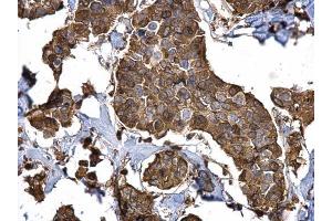 IHC-P Image Stathmin 1 antibody detects Stathmin 1 protein at cytosol on human breast carcinoma by immunohistochemical analysis. (Stathmin 1 抗体  (C-Term))