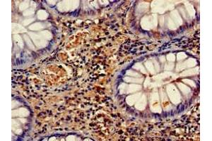 Immunohistochemistry of paraffin-embedded human colon cancer using ABIN7158660 at dilution of 1:100 (HELLS 抗体  (AA 550-600))