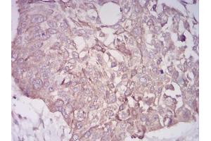 Immunohistochemical analysis of paraffin-embedded esophageal cancer tissues using BMP7 mouse mAb with DAB staining. (BMP7 抗体  (AA 239-431))