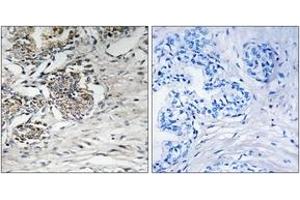 Immunohistochemistry analysis of paraffin-embedded human prostate carcinoma tissue, using Claudin 7 (Ab-210) Antibody. (Claudin 7 抗体  (AA 162-211))