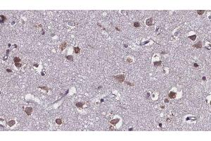 ABIN6275586 at 1/100 staining Human brain cancer tissue by IHC-P. (SLC28A2 抗体  (Internal Region))