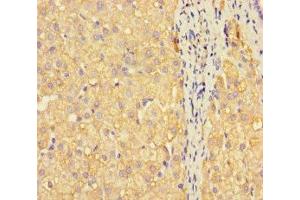 Immunohistochemistry of paraffin-embedded human liver cancer using ABIN7159675 at dilution of 1:100 (METTL7A 抗体  (AA 30-244))