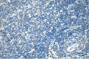 Immunohistochemistry was performed on paraffin-embedded human lymphoma using RAD23A antibody (ABIN7800116), 1:200).