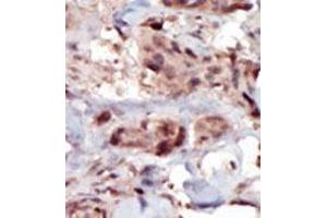 Formalin-fixed and paraffin-embedded human cancer tissue (breast carcinoma) reacted with the primary antibody, which was peroxidase-conjugated to the secondary antibody, followed by AEC staining. (SPHK2 抗体  (C-Term))