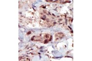 Formalin-fixed and paraffin-embedded human cancer tissue (breast carcinoma) reacted with the primary antibody, which was peroxidase-conjugated to the secondary antibody, followed by AEC staining. (SPHK2 抗体  (C-Term))