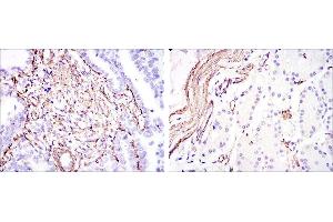 Immunohistochemical analysis of paraffin-embedded stomach cancer (left) and stomach tissues (right) using ACTA2 mouse mAb with DAB staining. (Smooth Muscle Actin 抗体)