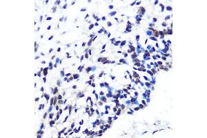 Immunohistochemistry of paraffin-embedded human esophageal cancer using POU2F1/POU2F1/OCT1 Rabbit mAb (ABIN7269495) at dilution of 1:100 (40x lens). (POU2F1 抗体)
