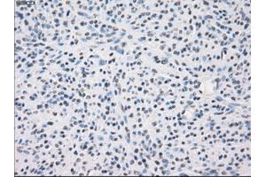 Immunohistochemical staining of paraffin-embedded Carcinoma of thyroid tissue using anti-FCGR2A mouse monoclonal antibody. (FCGR2A 抗体)