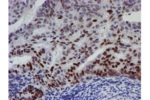 Immunohistochemical staining of paraffin-embedded Adenocarcinoma of Human endometrium tissue using anti-UBE2E3 mouse monoclonal antibody. (UBE2E3 抗体)