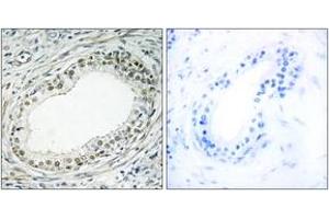 Immunohistochemistry analysis of paraffin-embedded human prostate carcinoma tissue, using RPL36 Antibody. (RPL36 抗体  (AA 51-100))