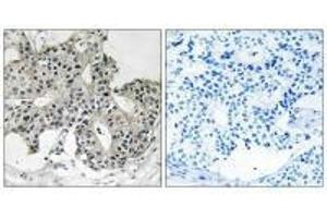 Immunohistochemistry analysis of paraffin-embedded human breast carcinoma tissue using PXMP3 antibody. (PEX2 抗体  (N-Term))