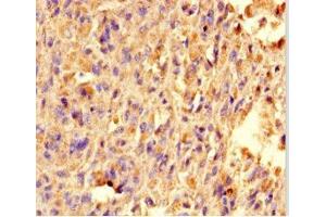 Immunohistochemistry of paraffin-embedded human melanoma using ABIN7172348 at dilution of 1:100 (TRAK1 抗体  (AA 101-300))