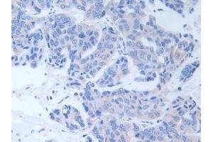 Detection of ALT in Human Breast cancer Tissue using Polyclonal Antibody to Alanine Aminotransferase (ALT) (ALT 抗体  (AA 255-492))