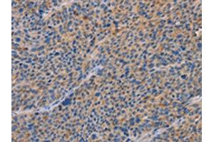 The image on the left is immunohistochemistry of paraffin-embedded Human liver cancer tissue using ABIN7192619(SPAG6 Antibody) at dilution 1/30, on the right is treated with synthetic peptide. (SPAG6 抗体)