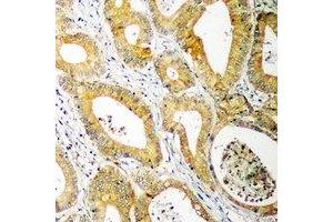 Immunohistochemical analysis of UBE2C staining in human colon cancer formalin fixed paraffin embedded tissue section. (UBE2C 抗体)