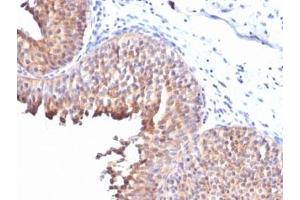 IHC testing of FFPE human bladder carcinoma with Keratin 10 antibody (clone KRT10/844). (Keratin 10 抗体)