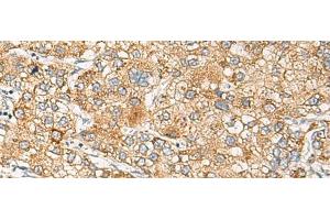 Immunohistochemistry of paraffin-embedded Human liver cancer tissue using CRABP1 Polyclonal Antibody at dilution of 1:120(x200) (CRABP1 抗体)