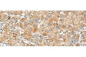 Immunohistochemistry of paraffin-embedded Human liver cancer tissue using CRABP1 Polyclonal Antibody at dilution of 1:120(x200) (CRABP1 抗体)