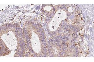 ABIN6272979 at 1/100 staining Human liver cancer tissue by IHC-P. (RAB3D 抗体  (Internal Region))