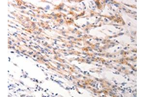 The image on the left is immunohistochemistry of paraffin-embedded Human lung cancer tissue using ABIN7191245(KRT6A/KRT6B/KRT6C Antibody) at dilution 1/40, on the right is treated with synthetic peptide. (KRT6A/KRT6B/KRT6C 抗体)