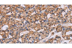 Immunohistochemistry (Paraffin-embedded Sections) (IHC (p)) image for anti-ArfGAP with RhoGAP Domain, Ankyrin Repeat and PH Domain 1 (ARAP1) antibody (ABIN7238555)