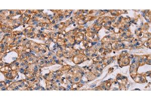 Immunohistochemistry of paraffin-embedded Human prostate cancer tissue using ARAP1 Polyclonal Antibody at dilution 1:40 (ARAP1 抗体)