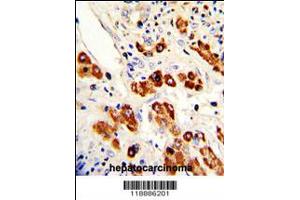 Formalin-fixed and paraffin-embedded human hepatocarcinoma with CEACAM Antibody (N-term), which was peroxidase-conjugated to the secondary antibody, followed by DAB staining. (CEACAM5 抗体  (N-Term))