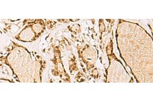 Immunohistochemistry of paraffin-embedded Human thyroid cancer tissue using NIPBL Polyclonal Antibody at dilution of 1:55(x200) (NIPBL 抗体)