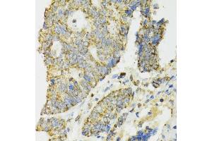 Immunohistochemistry of paraffin-embedded human colon carcinoma using IDH2 antibody. (IDH2 抗体)