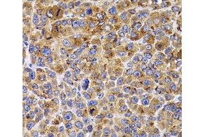 Immunohistochemistry of paraffin-embedded Mouse cancer using UBE2R2 Polyclonal Antibody at dilution of 1:100 (40x lens). (UBE2R2 抗体)
