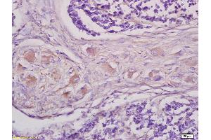 Formalin-fixed and paraffin embedded human lung carcinoma tissue labeled with Anti GRM1 Polyclonal Antibody,Unconjugated (bs1803R) at 1:200 followed by conjugation to the secondary antibody and DAB staining. (mGluR1 + mGluR5 抗体  (AA 651-750))