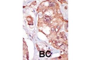 Formalin-fixed and paraffin-embedded human cancer tissue reacted with the primary antibody, which was peroxidase-conjugated to the secondary antibody, followed by AEC staining. (TNK1 抗体  (AA 256-286))