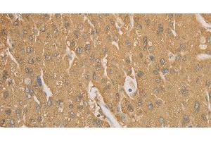 Immunohistochemistry of paraffin-embedded Human liver cancer tissue using CD40 Polyclonal Antibody at dilution 1:70 (CD40 抗体)