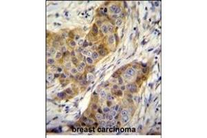 ANR39 Antibody (C-term) (ABIN655104 and ABIN2844736) immunohistochemistry analysis in formalin fixed and paraffin embedded human breast carcinoma followed by peroxidase conjugation of the secondary antibody and DAB staining. (ANKRD39 抗体  (C-Term))