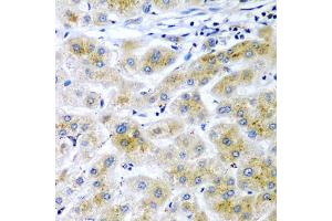 Immunohistochemistry of paraffin-embedded human liver cancer using RARRES2 antibody (ABIN5974187) at dilution of 1/200 (40x lens). (Chemerin 抗体)