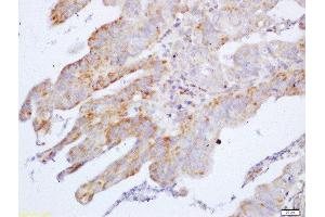 Formalin-fixed and paraffin embedded human gastric carcinoma labeled with Anti-Cyclin M2 Polyclonal Antibody, Unconjugated  at 1:200 followed by conjugation to the secondary antibody and DAB staining (Cyclin M2 抗体  (AA 51-150))