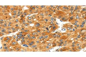 Immunohistochemistry of paraffin-embedded Human liver cancer tissue using STXBP4 Polyclonal Antibody at dilution 1:40 (STXBP4 抗体)