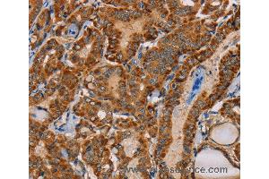 Immunohistochemistry of Human cervical cancer using MBNL3 Polyclonal Antibody at dilution of 1:30 (MBNL3 抗体)
