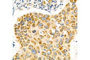 Immunohistochemistry of paraffin embedded human lung cancer using Notch4 (ABIN7074863) at dilution of 1:600 (400x lens) (NOTCH4 抗体)
