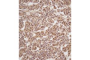 Immunohistochemical analysis of (ABIN657470 and ABIN2846498) on paraffin-embedded Human breast carcinoma tissue. (Estrogen Receptor alpha 抗体  (AA 246-273))