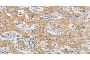 Immunohistochemistry of paraffin-embedded Human gasrtic cancer tissue using HIPK4 Polyclonal Antibody at dilution 1:30 (HIPK4 抗体)