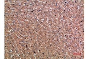 Immunohistochemical analysis of paraffin-embedded human-liver-cancer, antibody was diluted at 1:200 (Chordin 抗体  (AA 905-954))